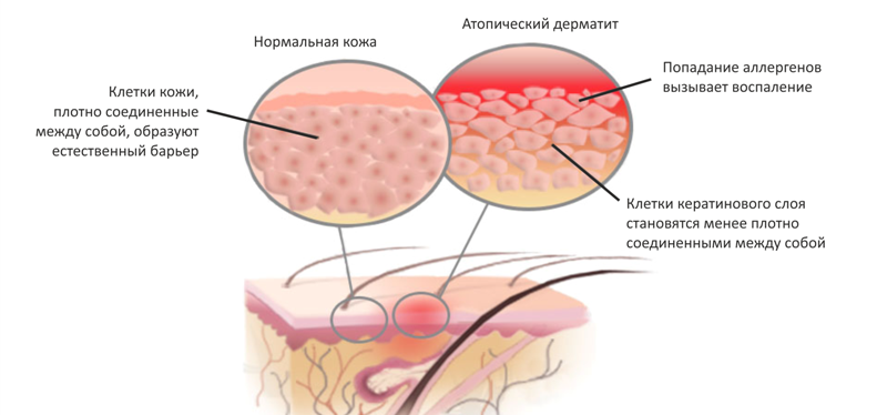 Атопический дерматит схема