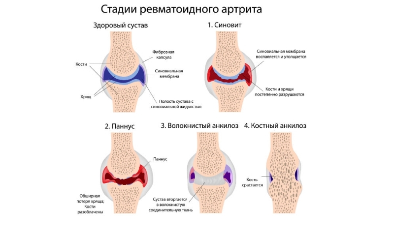 стадии развития артрита