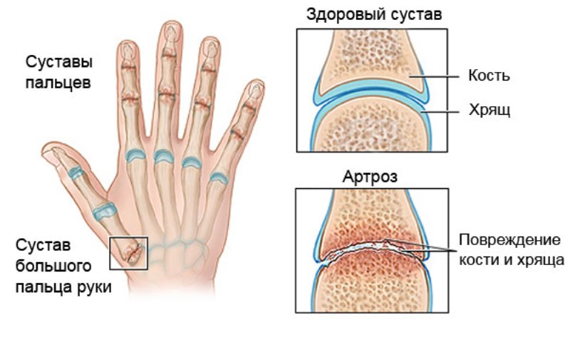 здоровые и пораженные суставы