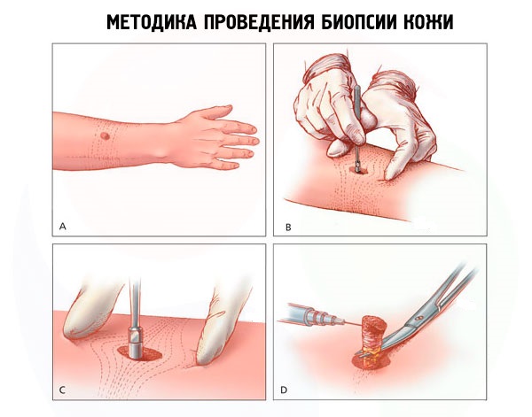 Биопсия кожных покровов