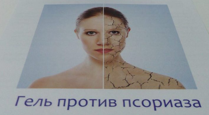 гели от псориаза