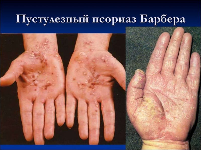 Псориаз Барбера