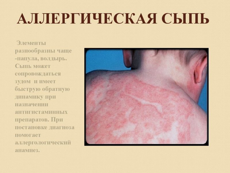 аллергическая сыпь