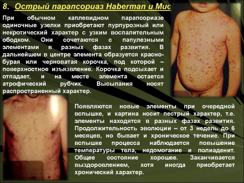 парапсориаз