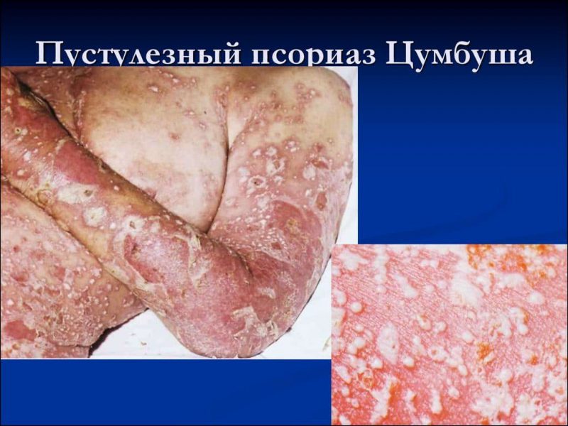 псориаз Цумбуша