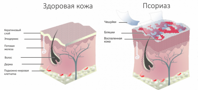 псориаз причины
