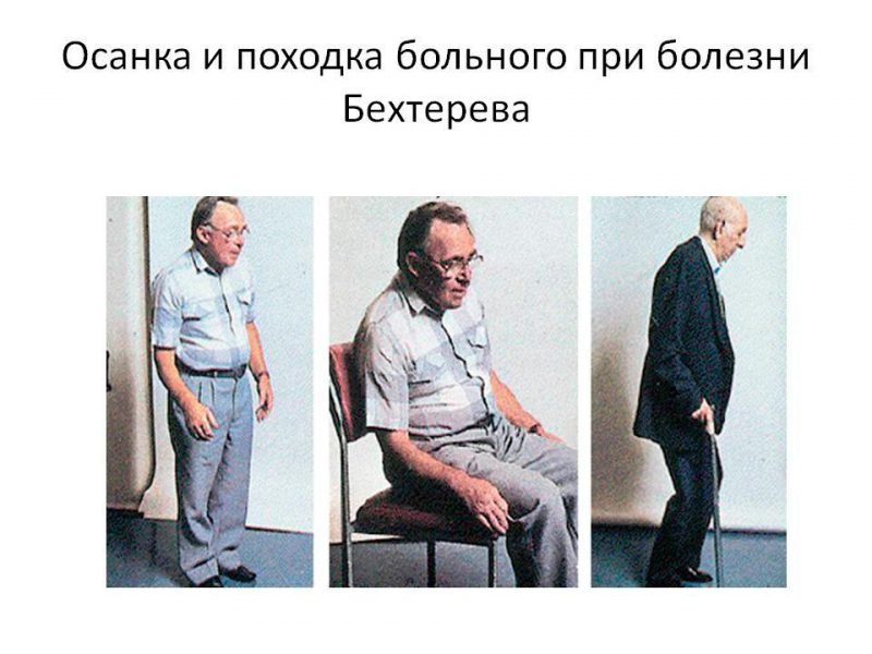 Болезнь Бехтерева поражает суставы человека
