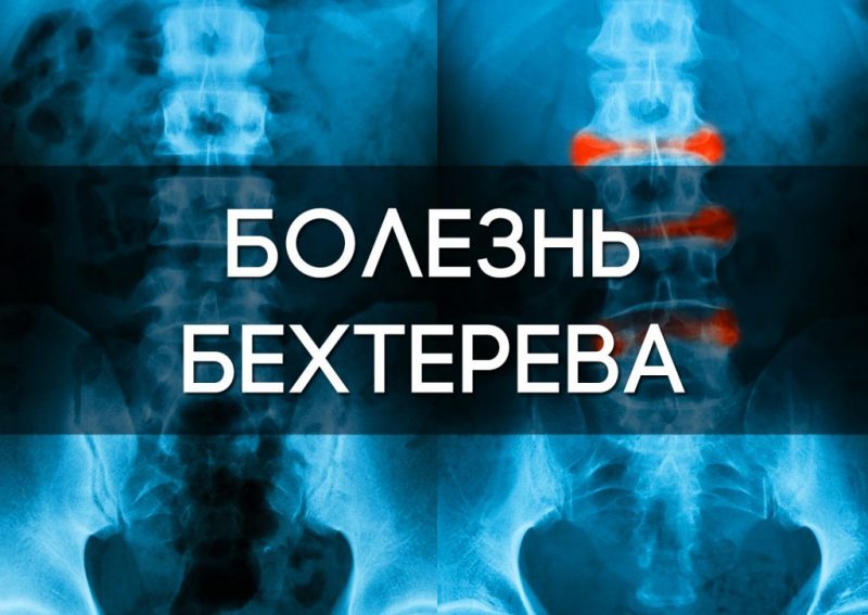 болезнь Бехтерева