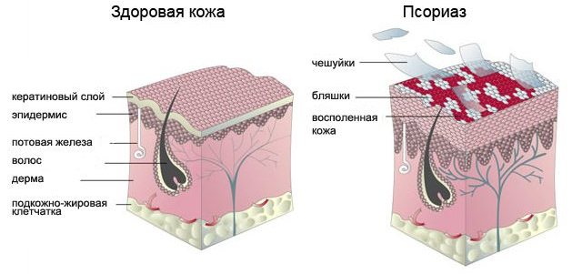 стадии псориаза