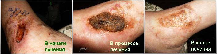Лечение псориаза по схеме препаратом фракция асд 2