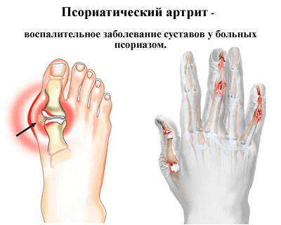 Псориатический артрит