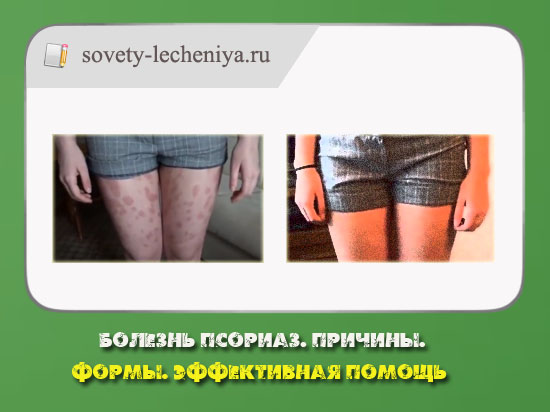 Болезнь псориаз