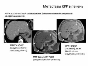 Метастазы в печени с чем можно спутать