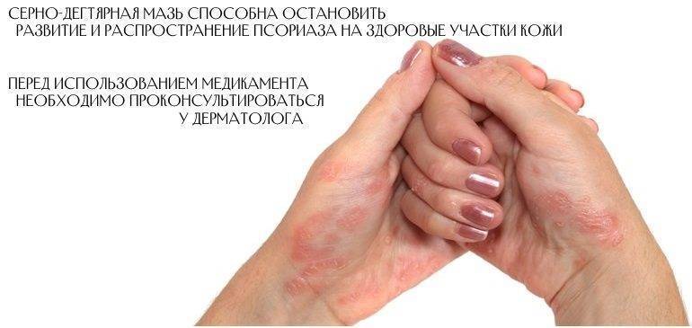 Серно-дегтярная мазь