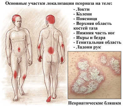 Лечение псориаза перекисью водорода : инструкция по применению