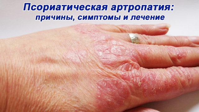Псориатическая артропатия: причины, симптомы, лечение