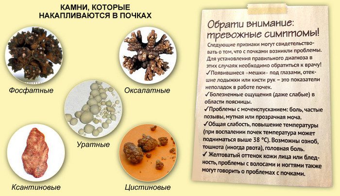 камни в почках сколько лежат в больнице