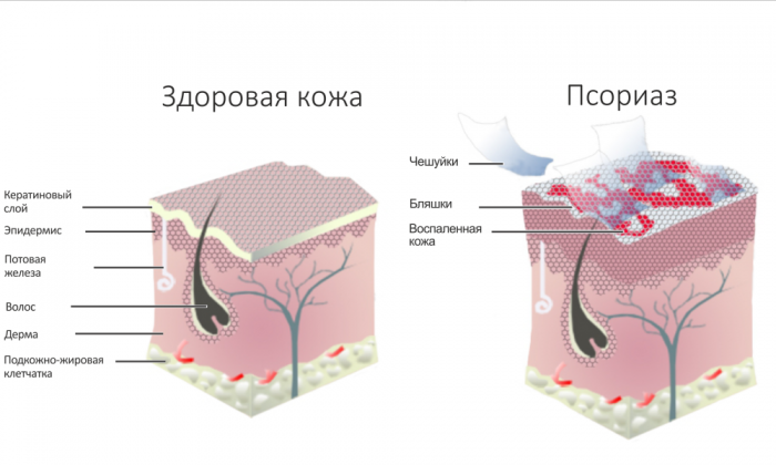 псориаз кожи