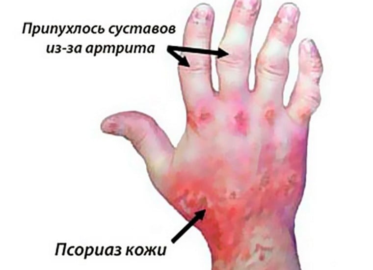 Диета при псориатическом артрите суставов: меню питания
