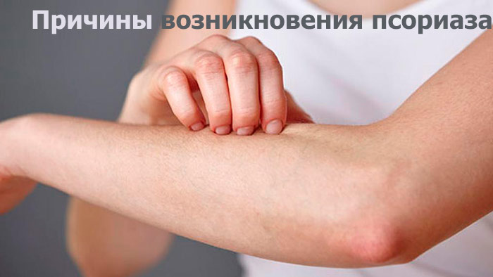 причины возникновения псориаза