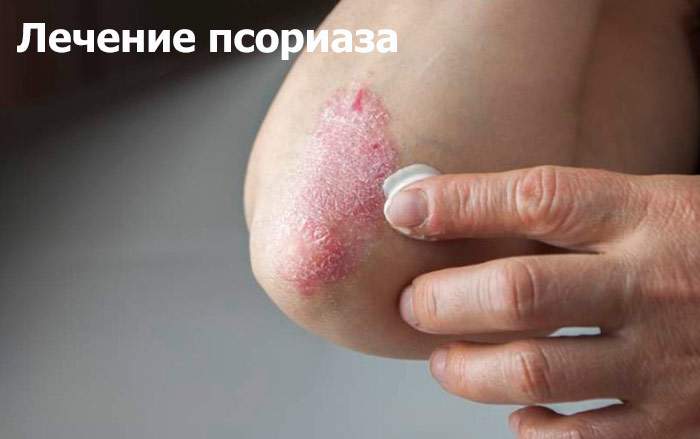 лечение псориаза