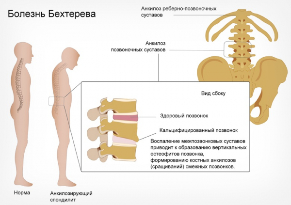 Болезнь Бехтерева