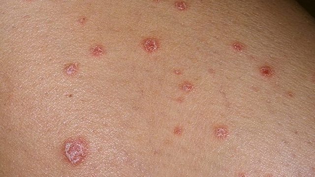 Почему появляются красные зудящие пятна на теле?