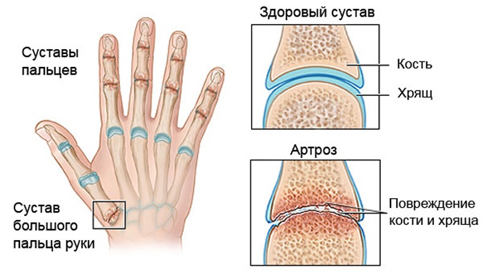 Солевые ванночки для рук при артрозе