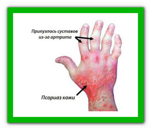 Псориатический артрит - симптомы и проявление. Лечение и диета при псориатическом артрите суставов