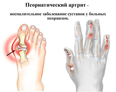 Псориатический артрит: симптомы, лечение, фото