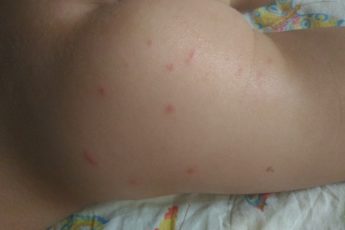 От чего появляется сыпь похожая на укусы комаров и как она выглядет