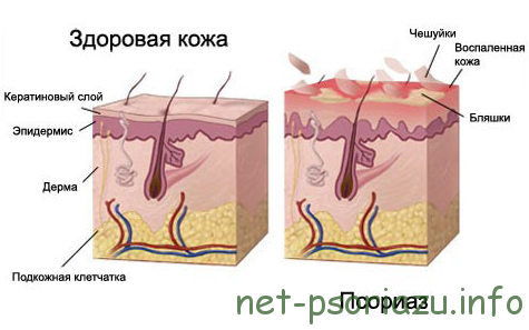 История болезни псориаз