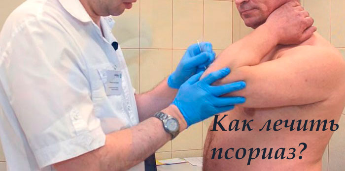 как лечить псориаз