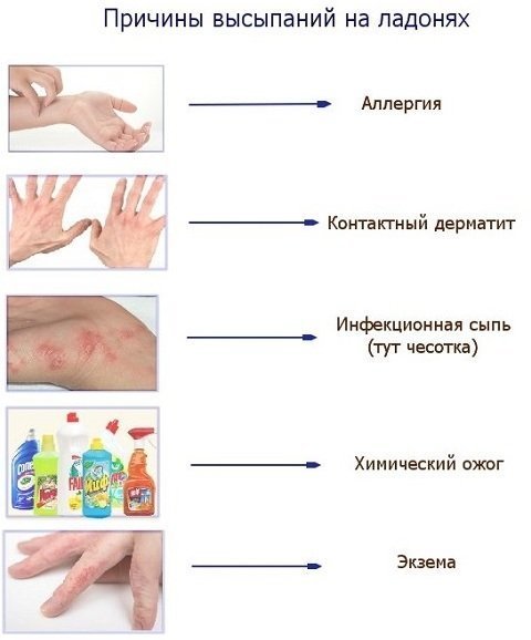 Сыпь на ладонях: высыпания в виде пузырьков, лечение