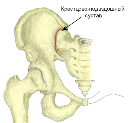 Сакроилеит тазобедренного сустава
