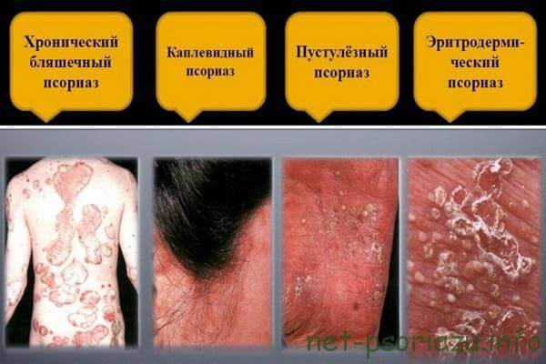 Псориаз на теле