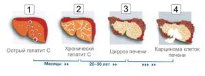 Цирроз печени, как осложнение при ВИЧ-инфекции