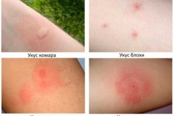От чего появляется сыпь похожая на укусы комаров и как она выглядет