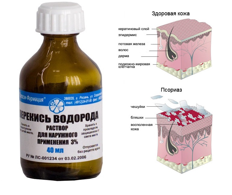 Лечение псориаза перекисью водорода - Сайт о методах лечения ...
