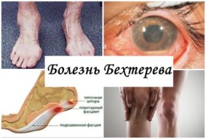 Спондилоартрит: что это такое, симптомы, лечение
