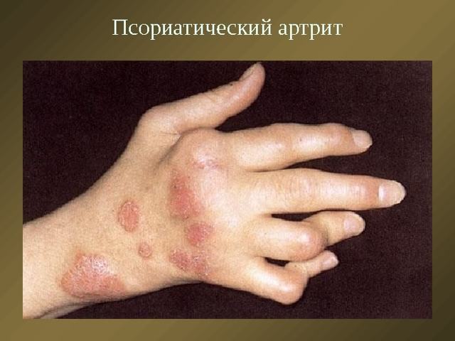 Инвалидность при артрите ревматоидного и псориатического вида