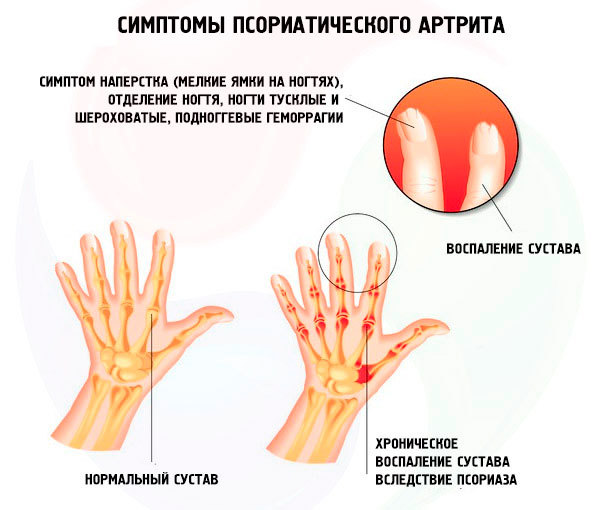 Псориатический артрит: симптомы, лечение, фото