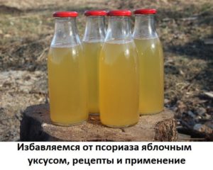 Яблочный уксус при псориазе