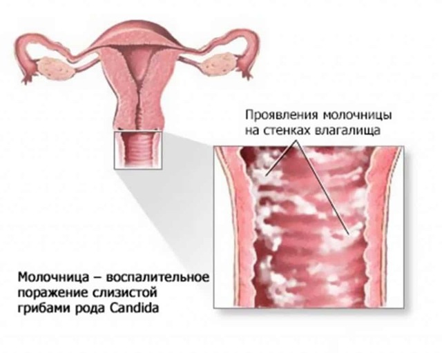 Как понять что у тебя молочница: простой тест