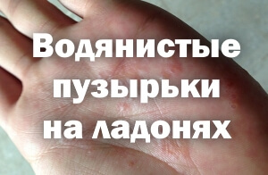Сыпь на ладонях: высыпания в виде пузырьков, лечение