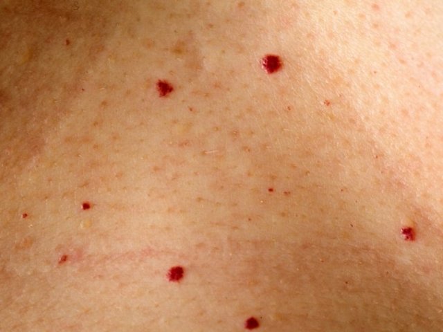 Красные пятна на коже – причины, фото и как избавиться