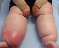 О чем говорят показатели содержания мочевой кислоты в крови?
