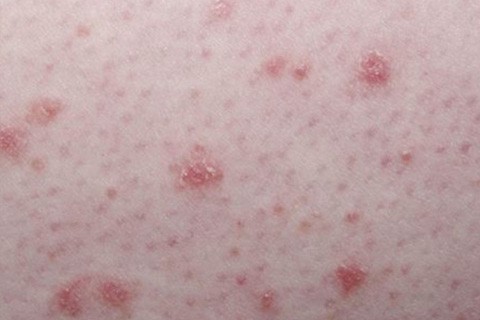Каплевидный псориаз: симптомы и лечение