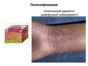 Распространенный атопический дерматит с очаговой лихенификацией