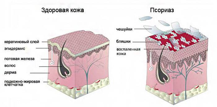 кожа, поражённая псориазом